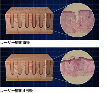 レーザー照射の図