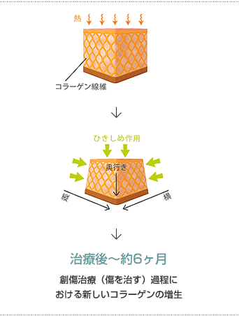 熱によるコラーゲンや繊維組織の収縮図